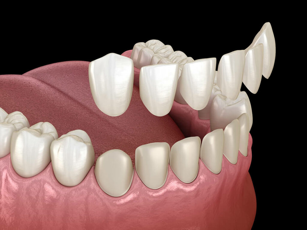 Graphic of porcelain dental veneers being placed on top of natural teeth.