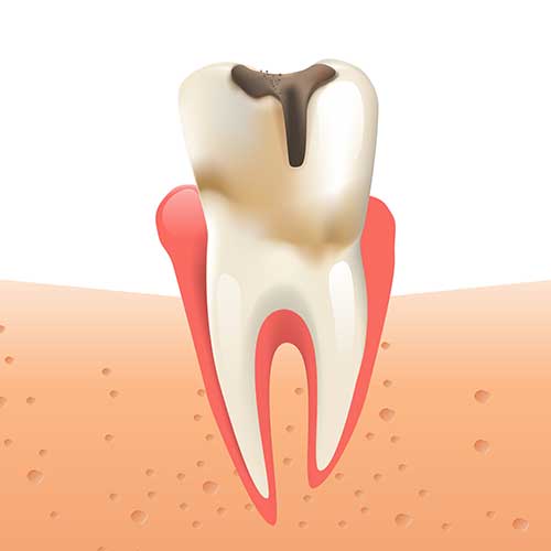 Graphic of a tooth with a severe cavity.