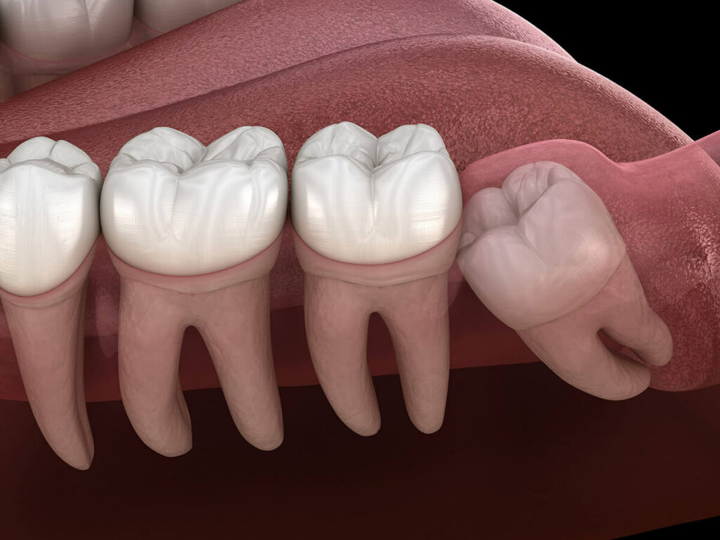Graphic showing an impacted wisdom tooth, pushing against the other molars from under the surface of the gums.