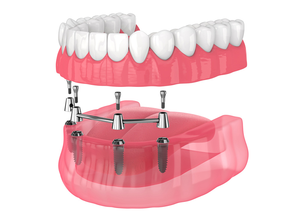Graphic showing the hardware and placement of all-on-4 dental implants.