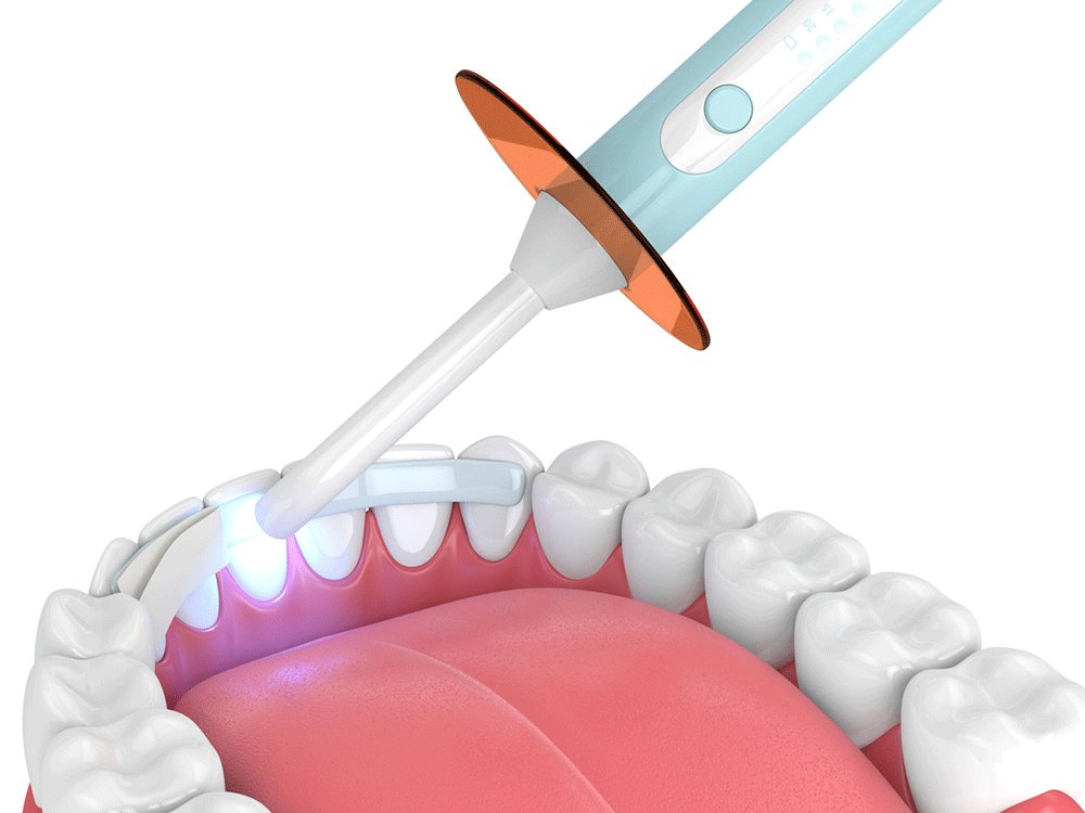 Graphic depicting a dental bonding procedure.