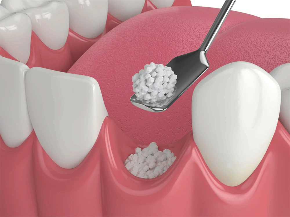 Graphic showing the dental bone grafting procedure
